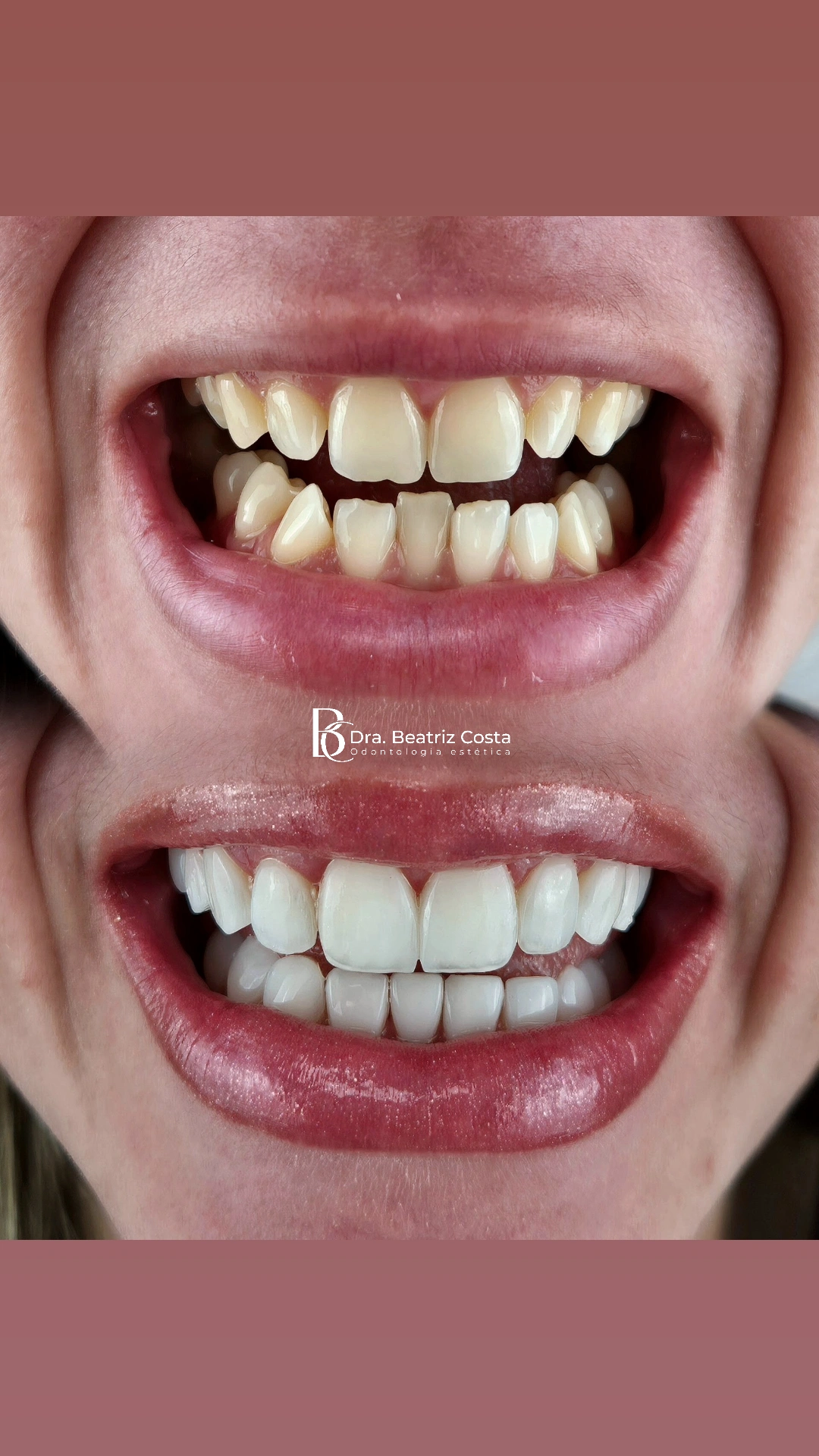 Sorriso antes e depois — correção estética