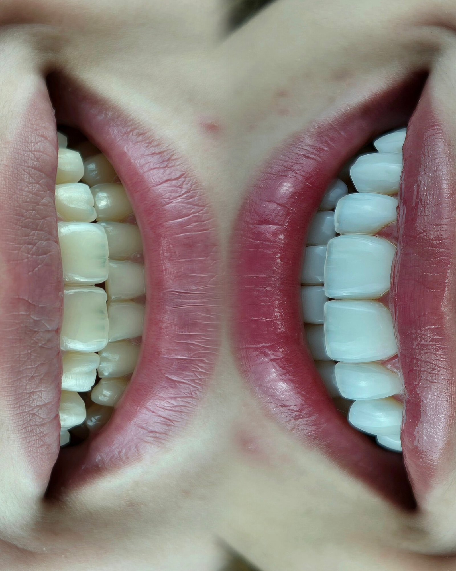 Sorriso antes e depois — facetas e brilho