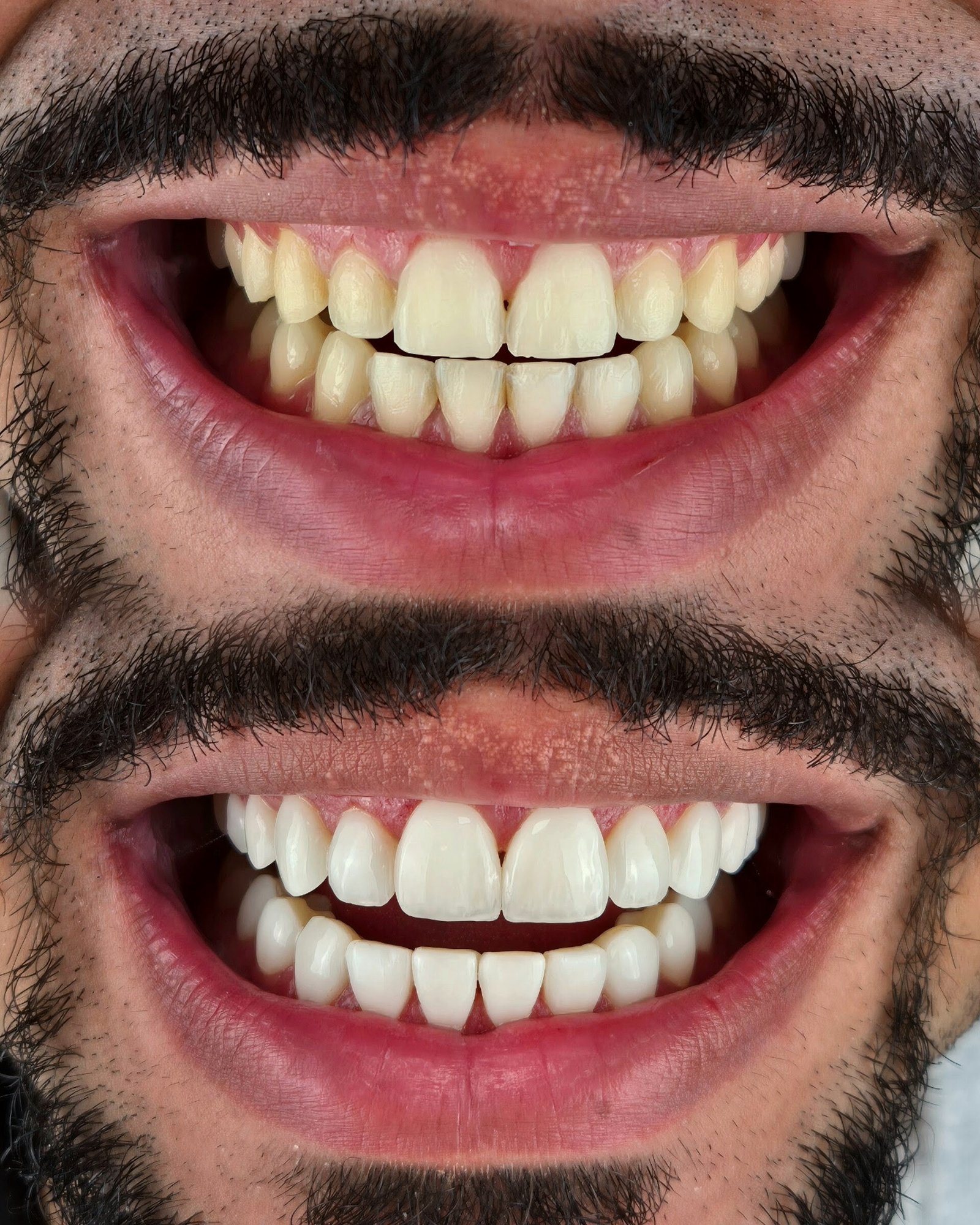 Sorriso antes e depois — lentes e formato